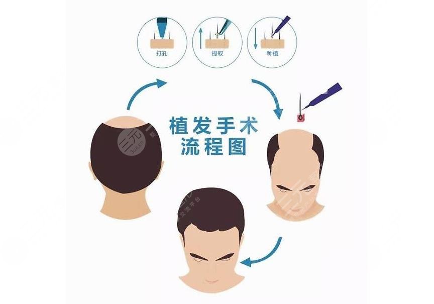 植发后的xiao果可以维持多久?