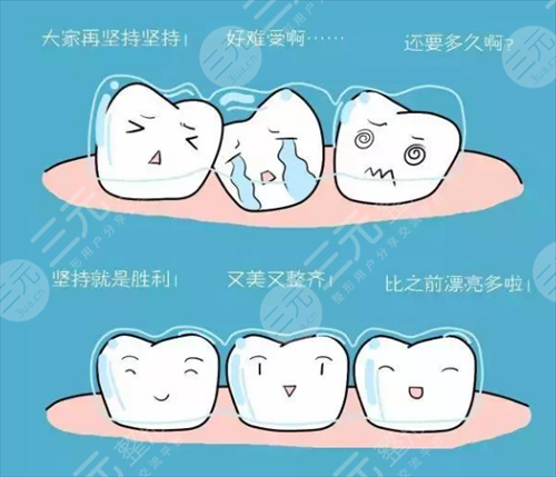 隐形牙齿矫正过程图片：可以悄悄的矫正牙齿！