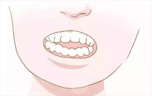 牙齿矫正后的果是*性的吗?