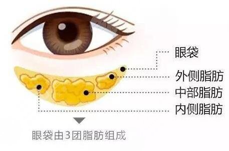 金鱼眼整形需要注意哪些问题 金鱼眼袋预防指南