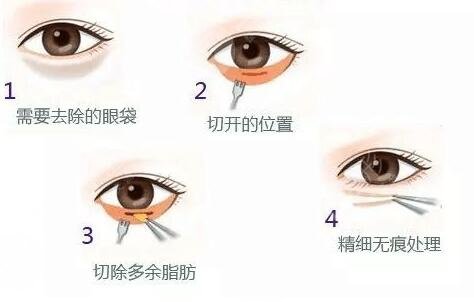 【眼部除皱方法】眼部除皱有哪些方法 眼部除皱用什么方法好