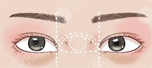 眼窝填充多久恢复正常？