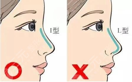 膨体隆鼻手术案例
