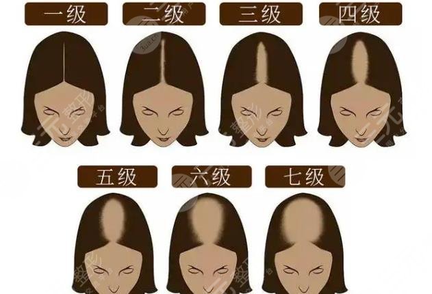 女性脱发等级分类图解图片
