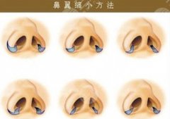 北京鼻翼缩小手术价钱有哪些影响因素？鼻翼缩小手术会有危害吗？