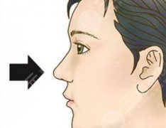 耳软骨隆鼻缺点有哪些？美鼻小课堂带你深入了解，手术常识！