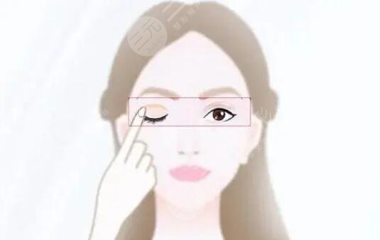 双眼皮手术有几种款式?