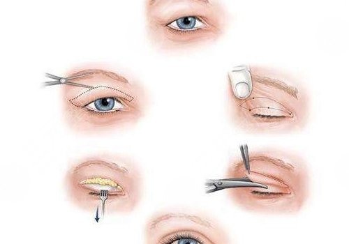 双眼皮全切恢复期要多久？