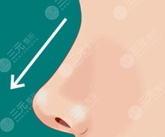 强生瑆珀假体缺点有哪些？适合鼻梁还是鼻尖？能够在体内放多久？