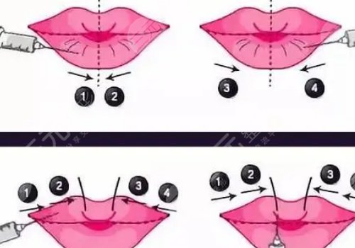 玻尿酸丰唇能维持多久？