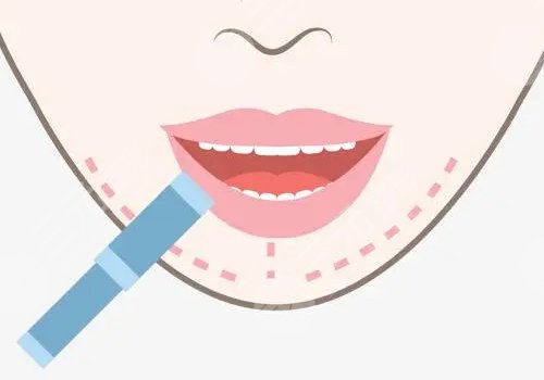 玻尿酸丰唇多久消肿？能维持多久？