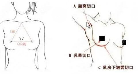 假体隆胸切口在什么位置比较好？常用三个切口位置，优缺点告诉你！
