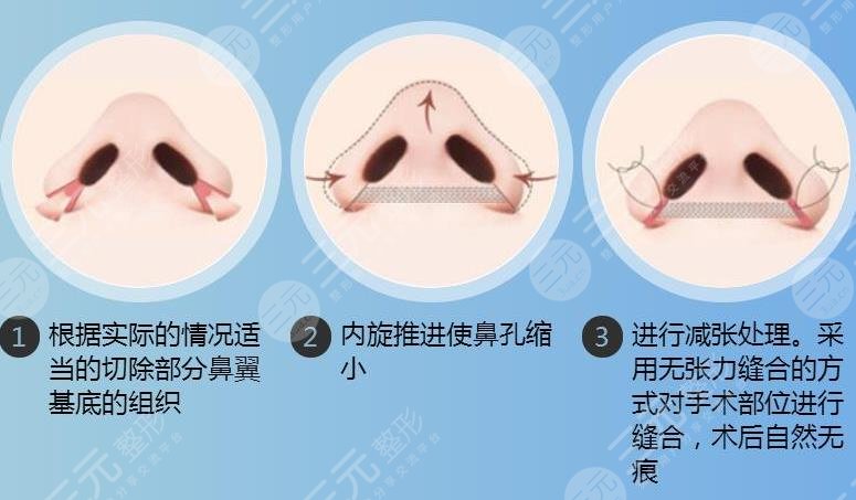 武汉同济医院鼻翼缩小案例图