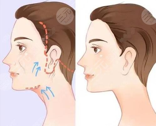 面部拉皮手术切口在什么位置？术前科普，带你了解除皱提升的秘密！