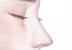耳软骨和肋骨鼻子的区别在哪里？可以维持多久？哪种自然？