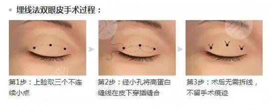 上海悦薇堂管果做双眼皮怎么样