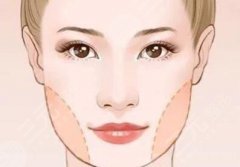 下颌缘提升多久出效果？面部塑形指南，4种方法各不同！